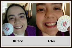 professional whitening system